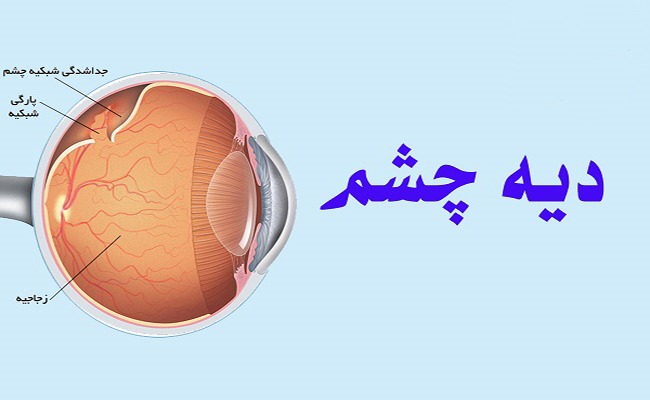 نحوه محاسبه دیه چشم